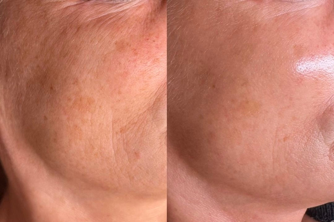 Laser Skin Rejuvenation Cheeks