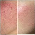 Laser Facial for Redness/Broken Capillaries