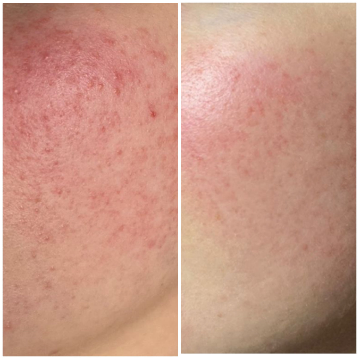 Laser Facial for Redness/Broken Capillaries