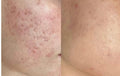 Laser Acne Facial