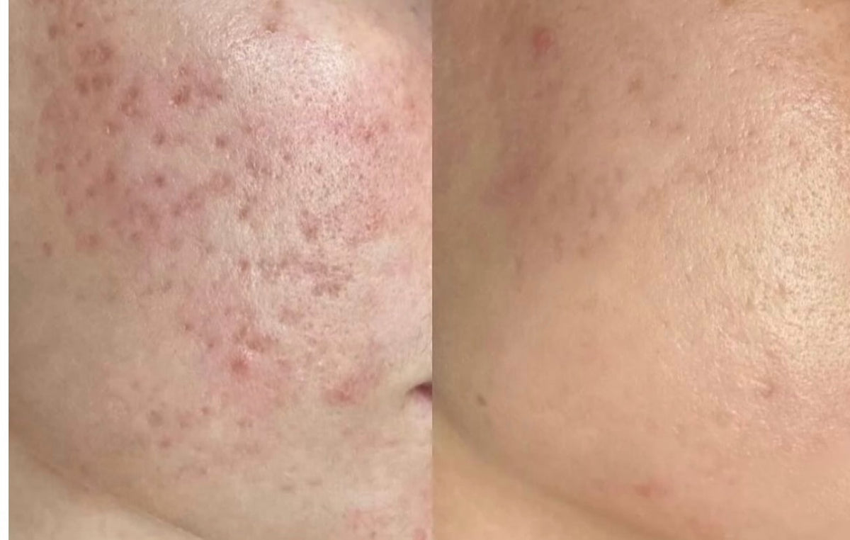 Laser Acne Facial
