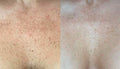 Laser Skin Rejuvenation Chest
