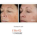 Laser Skin Rejuvenation Full Face