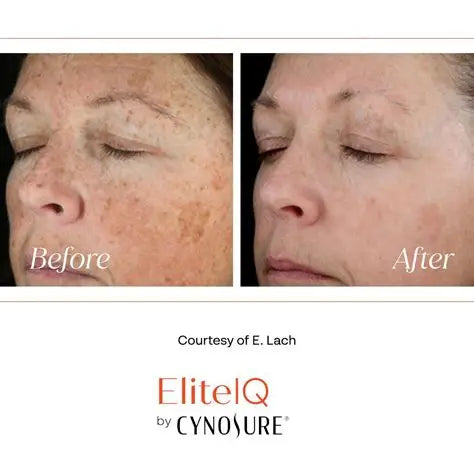 Laser Skin Rejuvenation Full Face